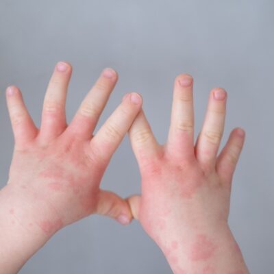 A child with with a skin condition on their hands.